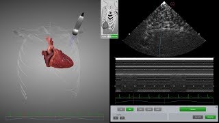 HeartWorks Pneumothorax [upl. by Ttayh]