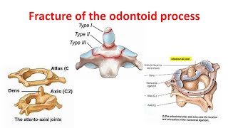 Fracture of the dens Odontoid process Classification clinical features amp treatment [upl. by Ilrahs922]