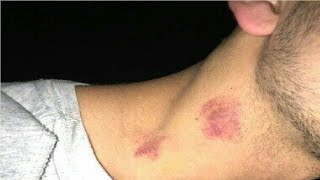 how to give a hickey for beginners easy [upl. by Eibur126]