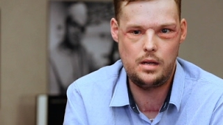 Face Transplant Links Men Touched by Tragedy [upl. by Elayne]