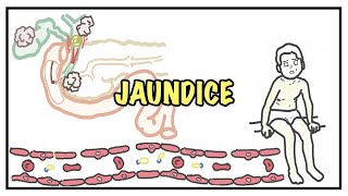 Approach to Jaundice  types and causes of hyperbilirubinemia investigations [upl. by Manon188]