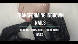 Watch this nail go from INGROWN toenail to flat and beautiful pedicure ingrowntoenail nailcare [upl. by Prissy36]