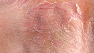 Eczema GRAPHIC Fast Outbreak Treatment Options  Eczema Dermatitis Rash Treatment 2015 [upl. by Kauppi666]