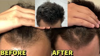 He REVERSED Hair Loss With JUST Dutasteride and Microneedling UNBELIEVABLE RESULTS [upl. by Bilicki]