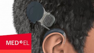 How Do Cochlear Implants Work The SYNCHRONY Cochlear Implant  MEDEL [upl. by Edyaw]