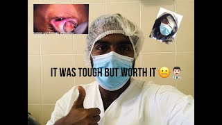 Chalazion removal Surgery  My Journey with Chalazia for 6 months amp Management Tips 👨🏻‍⚕️ [upl. by Corenda]