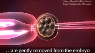 Preimplantation Genetic Diagnosis PGD [upl. by Juliet185]