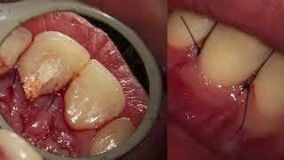 Biodentine  BioRoot  Invasive Cervical Resorption  Dr Adrián Lorenzo [upl. by Htims]