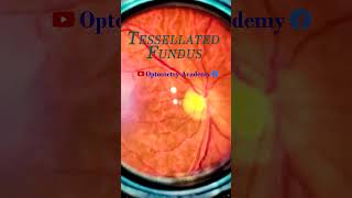 Tessellated Fundus  Indirect Ophthalmoscopy  Smartphone Fundus Videography  Short Video 58 [upl. by Deehahs]