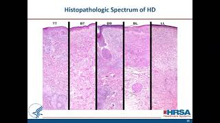 When to Suspect Leprosy Clinical Aspects and Treatment of Uncomplicated Hansens Disease [upl. by Cassella]