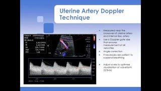 Advanced Fetal Doppler Webinar with Piotr Niznik [upl. by Isidor]