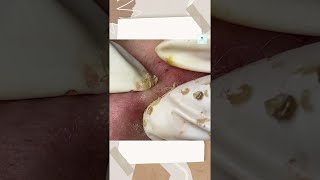 Big Cystic Acne Blackheads Extraction Blackheads amp Milia Whiteheads Removal Pimple Popping shorts [upl. by Drahsir486]