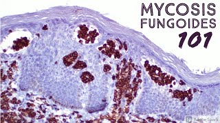 Mycosis Fungoides 101 Cutaneous Tcell Lymphoma CTCL for Dermatopathology Pathology Dermatology [upl. by Avis590]