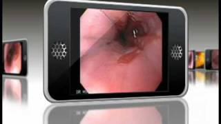 Barrett Esophagus Endoscopic Animation [upl. by Halet462]