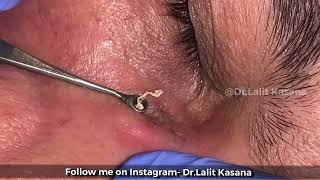 Blackhead Jelly Bean Extraction From Behind the Neck [upl. by Hayton]