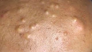 How To Remove Blackheads And Whiteheads On Face Easy 122 ✦ Dr Laelia ✦ [upl. by Manley]