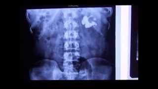 Intravenous Pyelogram  Intravenous Nephrogram  Intravenous Pyelography IVP in Staghorn Calculus [upl. by Rhyne74]