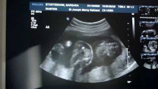 Twins20 week ultrasound [upl. by Seebeck]