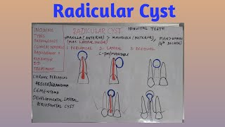 Radicular cyst [upl. by Caria]