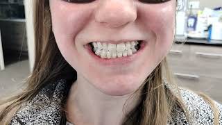 SureSmile Clear Aligners with rubber bands to correct the bite and align the teeth [upl. by Mond747]