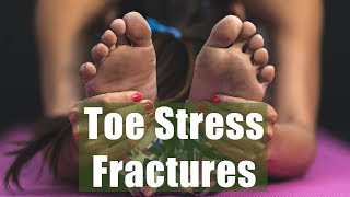 Stress Fractures in the toes from running [upl. by Nalon951]