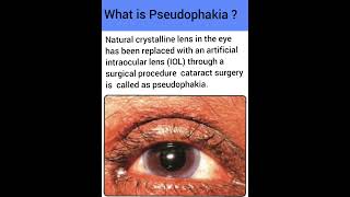 What is Pseudophakia  Optometry Fans [upl. by Onej]