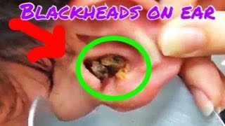 4 Year Old Boys Biggest Earwax Removal  earwax extraction fro the first time [upl. by Nimsaj297]