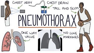 Pneumothorax [upl. by Annail]