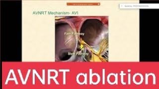 AVNRT ablation  AV nodal reentry tachycardia EPStudy Electrophysiology by DrNarendraKumar [upl. by Eisac]