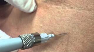 Treating angiomas amp DPNs on the chest with electrocautery For medical education NSFE [upl. by Gnaoh]