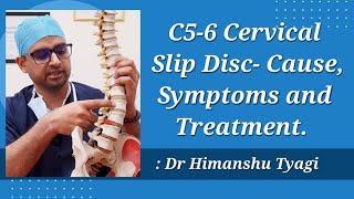 C5  C6 Cervical Slip Disc Cause Symptoms and Treatment [upl. by Ahcrop]