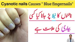 BluishPurple Discoloration Of Nails  Cyanotic Nails  ناخن کا رنگ نیلا پڑنے کی وجہ اور علاج [upl. by Jacobs]