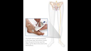 PTNS for overactive bladder [upl. by Oiramed]