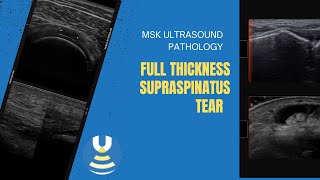 Full thickness Supraspinatus tendon tear on ultrasound [upl. by Brahear964]