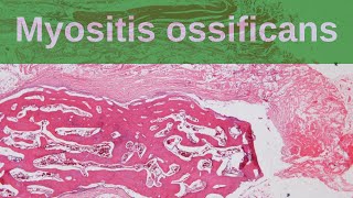 Myositis Ossificans  Pathology mini tutorials [upl. by Alletsirhc]