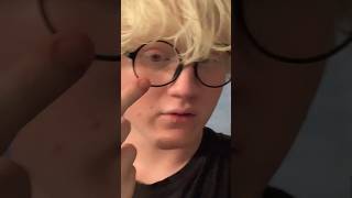 albeen albinismo albino albinism shorts youtubeshorts short viralvideo [upl. by Caz145]