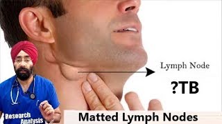 Matted Lymph Nodes क्या होता है  Lymphadenopathy  TB  DrEducation Hindi [upl. by Anitnemelc]