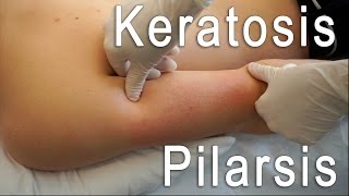 Keratosis Pilaris Clear  Brilliant Treatment FT Eric Smith  BLUSH Beverly Hills [upl. by Sandstrom254]