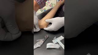 Treating Cubital Tunnel Syndrome [upl. by Moitoso585]