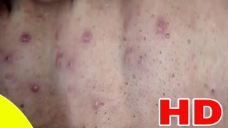 Cystic Acne ، Pimples And Blackheads Extraction Treatment On Face PART 09 [upl. by Yuh556]