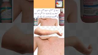 calamine lotion Uses benefits medicinereview [upl. by Torray187]