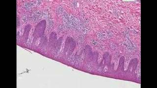 Histopathology SkinParapsoriasis [upl. by Kilam668]