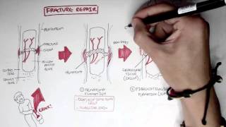 Bone Fracture  Types Fracture Repair and Osteomyelitis [upl. by Augustina381]