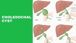 Choledochal Cyst neetpg usmle fmge [upl. by Derian]