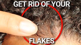 Why your scalp is flaky and HOW to FIX it [upl. by Idram396]