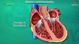 Dilated cardiomyopathy  DCM   Causes Signs and Symptoms Pathogenesis Diagnosis and Treatment [upl. by Liba]