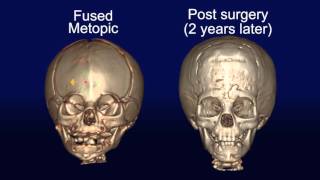 Metopic Synostosis [upl. by Eedrahc]