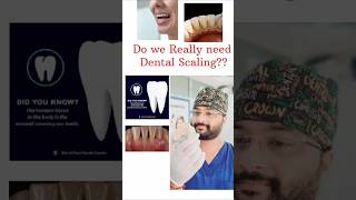 The Ultimate Guide to Dental Teeth Cleaning Everything You Need to Know yt shorts ytshorts [upl. by Aerdied]