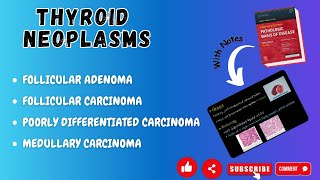 Thyroid NeoplasmFollicular Adenoma FollicularMedullaryPoorly differentiatedAnaplastic Carcinoma [upl. by Roselia]