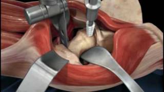 Direct Anterior Approach Hip Replacement [upl. by Ardine545]